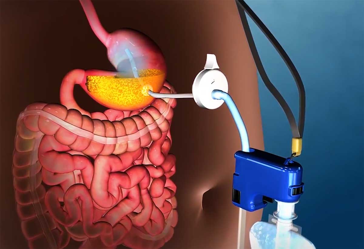 Пища в желудке. Трубочка в желудок для еды. Искусственный Желудко.